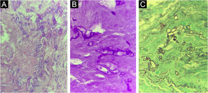 Corte histopatológico de peça cirúrgica do paciente com mucormicose rino‐órbito‐cerebral evidenciando hifas cenocíticas em aumento de 400×. (A), Hematoxilina & eosina. (B), Coloração pelo PAS. (C), Coloração pelo Grocott Gomori.