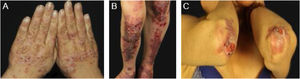 Epidermólise bolhosa adquirida (EBA) mecanobolhosa. (A), Vesículas e bolhas no dorso das mãos. (B), Erosões e cicatrizes hipertróficas nos joelhos e região pré‐tibial. (C), Erosões e cicatrizes atróficas com milia nos cotovelos.