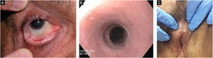 Complicações mucosas na epidermólise bolhosa adquirida. (A), Sinéquia conjuntival. (B), Subestenose esofágica. (C), Encapsulamento do clitóris e sinéquia dos lábios menores.