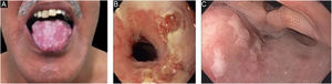 Comprometimento mucoso na epidermólise bolhosa adquirida. (A), Erosões no dorso da língua. (B), Bolhas e erosões na mucosa esofágica. (C), Erosões na parede posterior da hipofaringe.