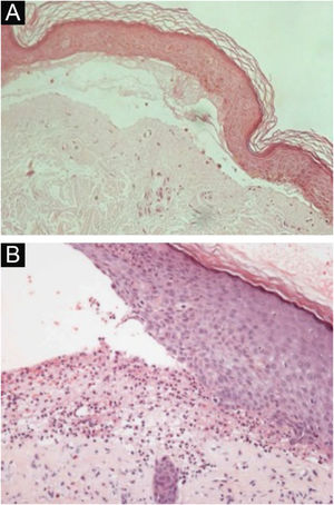 Exame anatomopatológico da epidermólise bolhosa adquirida com coloração por hematoxilina‐eosina. (A), Forma mecanobolhosa, com clivagem subepidérmica com infiltrado inflamatório escasso (200×). (B), Forma inflamatória, com clivagem dermoepidérmica e rico infiltrado inflamatório perivascular neutrofílico (400×).