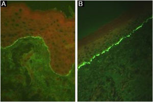 Imunofluorescência direta na epidermólise bolhosa adquirida. Fluorescência linear intensa e contínua na zona da membrana basal com anti‐IgG (A) e anti‐C3 (B); 400×.