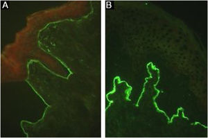Imunofluorescência indireta na epidermólise bolhosa adquirida. (A), Fluorescência linear intensa na zona da membrana basal com anti‐IgG (400×). (B), Fluorescência no lado dérmico da clivagem com a técnica de salt‐split skin utilizando anti‐IgG (400×).