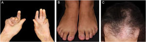 Complicações da pele e seus anexos na epidermólise bolhosa adquirida. (A), Atrofia da região palmar com contratura em flexão das mãos. (B), Anoníquia. (C), Alopecia cicatricial.