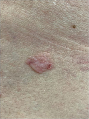 Placa normocrômica papilomatosa com centro levemente eritematoso.