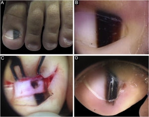 A, Aspecto clínico da ML ocupando 50% da espessura total do hálux esquerdo. B, Dermatoscopia à primeira consulta. C, Dermatoscopia intraoperatória, evidenciando lesão pigmentada de padrão irregular e borrão excêntrico. D, Dermatoscopia dois anos após biópsia, sinal de Hutchinson no hiponíquio.