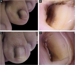 Aspecto clínico (A) e dermatoscópico (B) na primeira consulta. Aspecto clínico (C) e dermatoscópico (D) cinco anos após biópsia.