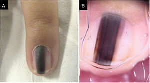(A), Aspecto clínico. (B), Dermatoscopia: irregularidade de cor e espessura, perda de paralelismo e bordas apagadas.
