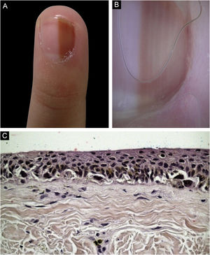 Aspecto clínico (A) e dermatoscópico (B) na primeira consulta; (C) exame histológico corado em H&E evidenciando proliferação de melanócitos em arranjo contínuo formando alguns ninhos na junção dermo‐epidérmica.