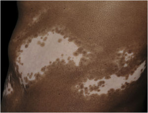 Vitiligo segmentar no flanco de paciente melanodérmico. Mácula acrômica, com distribuição zosteriforme. A periferia da lesão apresenta faixa de leucomelanodermia, com diversos pontos de repigmentação folicular. Fonte: arquivo dos autores.
