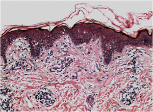 Vitiligo em atividade. Exame histopatológico: infiltrado linfocitário perivascular com agressão epidérmica e focos de degeneração vacuolar da camada basal (Hematoxilina & eosina, 40×). Cortesia da Dra. Lismary Mesquita.