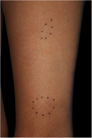 Nódulos subcutâneos na coxa esquerda.