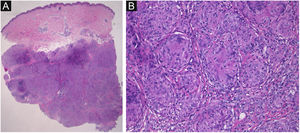 (A) Características histopatológicas mostrando localização densa de granulomas epitelioides não necrosantes no tecido subcutâneo (Hematoxilina & eosina, 12,5×). (B) Maior aumento revelando granulomas com células gigantes (Hematoxilina & eosina, 200×).