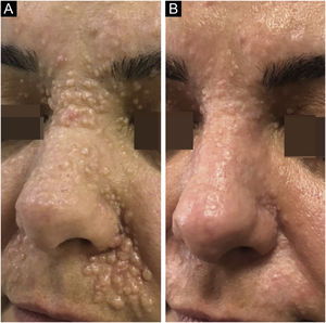 (A) Na hospitalização, foram detectadas múltiplas pápulas normocrômicas confluentes no dorso nasal, sulcos alares bilaterais e regiões nasolabiais. (B) No último controle, a pele do sulco nasolabial esquerdo apresentava discreta hipopigmentação. Regressão acentuada, com escore de 80% da paciente, foi observada nas partes restantes que receberam a aplicação de imiquimode associada a laser.