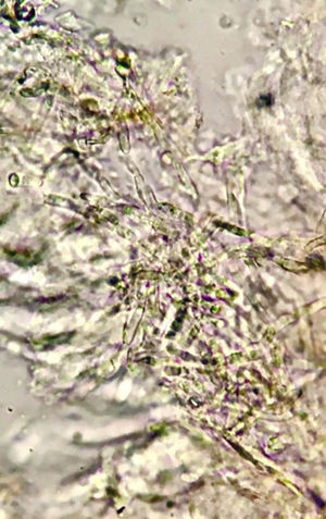 Hifas hialinas septadas com ramificação em ângulo agudo. Exame direto, KOH 20%, 40×.