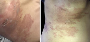 Placa eritemato‐acastanhada, descamativa, no hemitórax direito, com diagnóstico de carcinoma de mama metastático: topografia do FIW pós‐herpético.