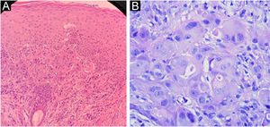 A. Histopatologia da placa do hemitórax direito: carcinoma pouco diferenciado à esquerda (Hematoxilina & eosina, 100×); B. à direita (Hematoxilina & eosina, 400×).
