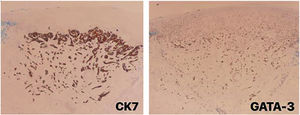 Painel imuno‐histoquímico do carcinoma mamário metastático: marcadores CK7 e GATA‐3 positivos.