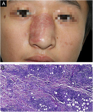 A, Imagem clínica mostrando placa avermelhada bem circunscrita no dorso nasal com borda levemente elevada e alguma descamação na superfície. B, O exame histopatológico da primeira biópsia mostra infiltrado inflamatório misto, incluindo linfócitos, histiócitos, eosinófilos e células gigantes multinucleadas, com formação de numerosos granulomas (Hematoxilina & eosina, 100×).