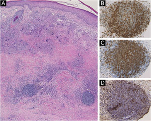 (A), Histopatologia mostrando histiócitos em paliçada dispostos horizontalmente e células gigantes multinucleadas ao redor do colágeno degenerado na derme. O exame imunohistoquímico mostrou que os agregados linfoides apresentaram imunorreatividade com CD3 (B), CD20 (C), e pNAd (D).