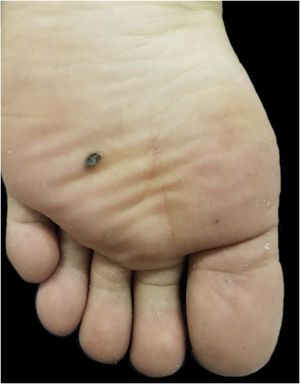Mácula enegrecida de 0,5cm na planta esquerda.