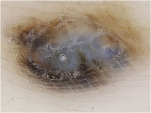 Dermatoscopia evidenciando véu azul esbranquiçado ao centro e pigmento acastanhado na periferia, com padrão fibrilar à 1 hora.