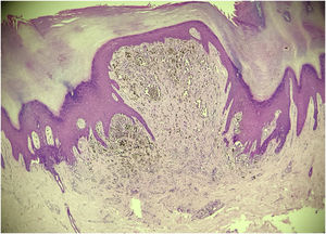 Exame histopatológico evidenciando nevo melanocítico composto fusocelular/epitelioide com caracteres de nevo de Spitz (Hematoxilina & eosina, 200×).