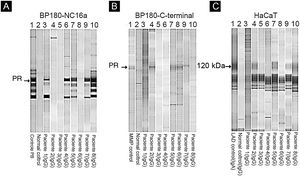 Immunoblotting utilizando BP180‐NC16a (A) C‐terminal BP180 (B) e células HaCaT (C) com amostras de soro. Para resultados positivos, procure a proteína de referência (PR) de: soro do paciente PB (penfigoide bolhoso) (A), MMP, soro do paciente com penfigoide das membranas mucosas (B) e LAD: soro do paciente com dermatose IgA linear (C).
