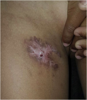 Evolução com melhora significativa das lesões após tratamento de prova para tuberculose.