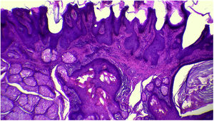 Imagem histológica panorâmica evidenciando discreta hiperceratose, acompanhada de acantose e papilomatose (Hematoxilina & eosina, 40×).