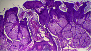 Hiperplasia e superficialização das glândulas sebáceas (Hematoxilina & eosina, 40×).