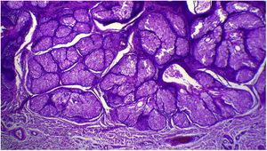 Detalhe da hiperplasia das glândulas sebáceas (Hematoxilina & eosina, 40×).