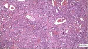 Proliferação de células epitelioides e fusiformes permeando canais e espaços vasculares malformados (Hematoxilina & eosina, 100×).