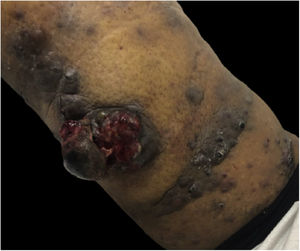 Aumento significativo do número de lesões satélites e da área de ulceração da tumoração central.