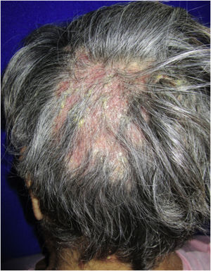 Placas pseudoalopécicas eritematosas, com pústulas e crostas amarelas afetando 70% do couro cabeludo.
