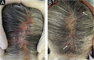 (A) Vista da linha média do couro cabeludo antes do tratamento. (B) Recuperação dos cabelos pós‐tratamento com cicatrizes diminutas (seta).