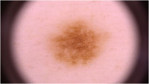 Mácula acastanhadas à dermatoscopia apresentando padrão reticular típico.