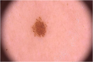 Pequena pápula acastanhada à dermatoscopia apresentando padrão globular típico.