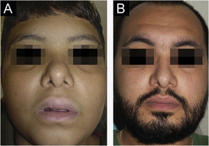 (A) Caso 4 ‐edema facial difuso. (B) Mesmo paciente, já adulto ‐ resolução completa do edema.