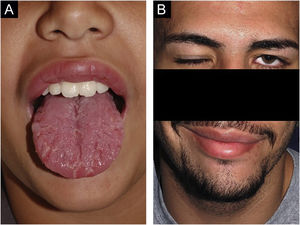 (A) Caso 6 ‐ macroqueilia, língua geográfica e fissurada. (B) Mesmo paciente, aos 19 anos, durante um surto de paralisia facial; a macroqueilia já havia desaparecido.