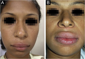 (A) Paciente 7 ‐ macroqueilia associada a leve edema facial. (B) Mesma paciente durante uma crise grave que se mostrou resistente às terapias.