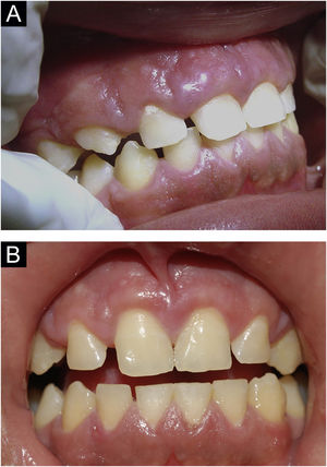(A) Caso 4 ‐ gingivite granulomatosa.10 (B) Mesmo paciente após a gingivoplastia.
