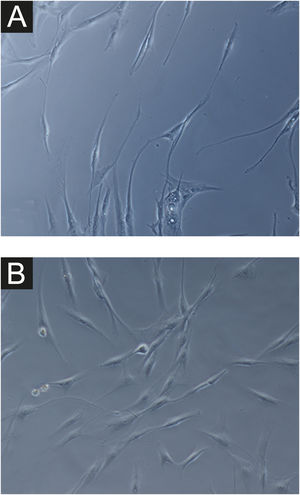 Microscopia de contraste de fase exibindo fibroblastos da pele com melasma facial (A) e da pele sã adjacente (B) em cultura celular (SA‐β‐gal, 400×), evidenciando menor densidade celular e morfologia menos alongada (fusiforme), mais larga, no melasma.