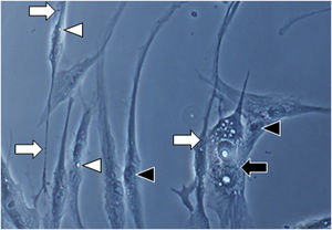 Em ampliação da Figura 1A (1000×): morfologia senescente dos fibroblastos da pele com melasma, evidenciando maior proporção de corpos justanucleares (seta preta), estruturas citoplasmáticas (SA‐β‐gal +) granulares frequentes (seta branca), gotículas de lipídeos (cabeça de seta branca), e nucléolos segmentados (cabeça de seta preta).