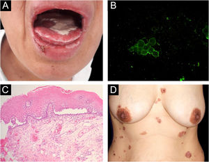 (a) Lesões na mucosa oral: erosões na língua recobertas por pseudomembrana esbranquiçada, erosões na mucosa labial, erosões e crostas no lábio inferior. (b) Imunofluorescência direta na citologia oral de Tzanck: fluorescência com anti‐IgG no envoltório dos ceratinócitos. (c) Histologia da mucosa oral (Hematoxilina & eosina, 40×): bolha suprabasal acantolítica. (d) Lesões cutâneas: placas eritematosas no abdômen e tórax com bolhas, erosões e crostas hemáticas.