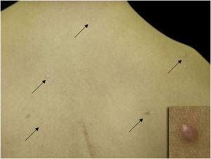 Pequenas pápulas ovais, discretamente eritematosas ou cor da pele espalhadas pelo dorso (setas).