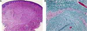 (A) Histopatologia mostrando feixes de colágeno espessados na derme (Hematoxilina & eosina, 40×). (B) A coloração Elastica‐Masson revelou fibras elásticas presentes apenas na área circundante (Elastica-Masson, 200×).
