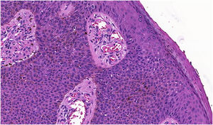 Poroma écrino pigmentado (Hematoxilina & eosina, 100×). Neoplasia formada por células cuboidais com citoplasma amplo, pequenas (menores que os queratinócitos), com depósito de melanina difusamente distribuído no interior da neoplasia. A neoplasia tem conexão com a epiderme, mas não forma paliçada periférica.