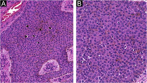 Poroma écrino pigmentado. (A) Área com melanócitos intratumorais evidentes (Hematoxilina & eosina, 100×). (B) Detalhe da formação de lumens intracitoplasmáticos incipientes no interior do tumor (Hematoxilina & eosina, 400×).