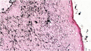 Poroma écrino pigmentado (Fontana‐Masson, 100×). Depósito difuso intratumoral de grânulos de melanina, com intensidade maior que a da epiderme suprajacente.